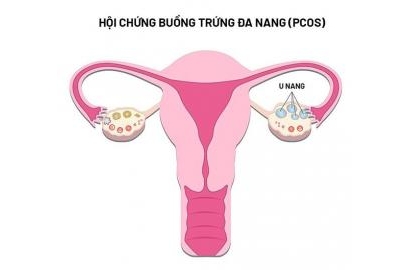 Hội chứng buồng trứng đa nang